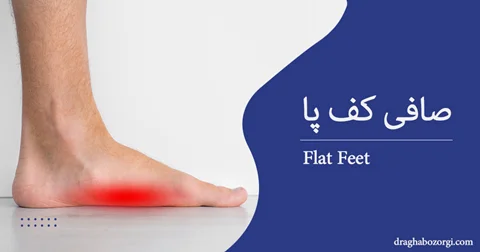 صافی کف پا، علل، عوارض و روشهای درمان